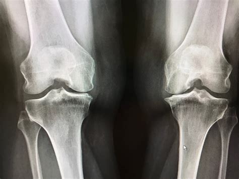 Everything You Need to Know About Knee X Rays: Quick and In-Depth Guide