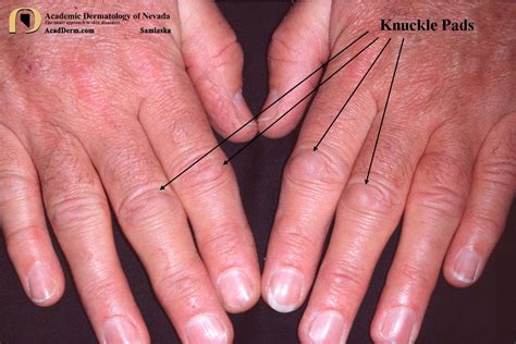 Knuckle Under Definition