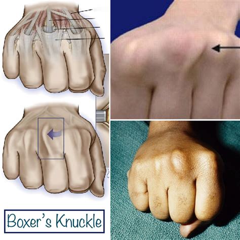 Knuckles Hurt While Boxing