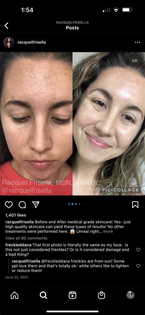 Kojic Acid Face Reddit