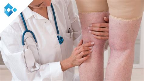 krampfadern behandeln