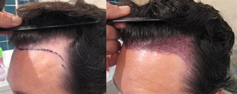 NeoGraft® is a minimally invasive hair transplant technique that can