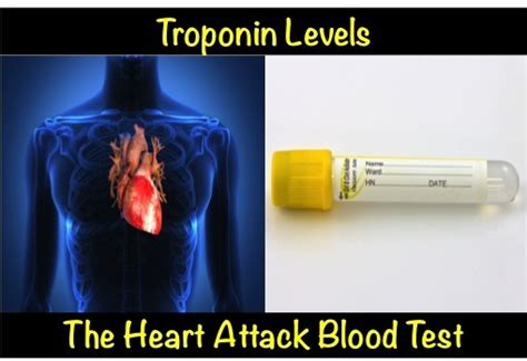 Lab Test For A Heart Attack