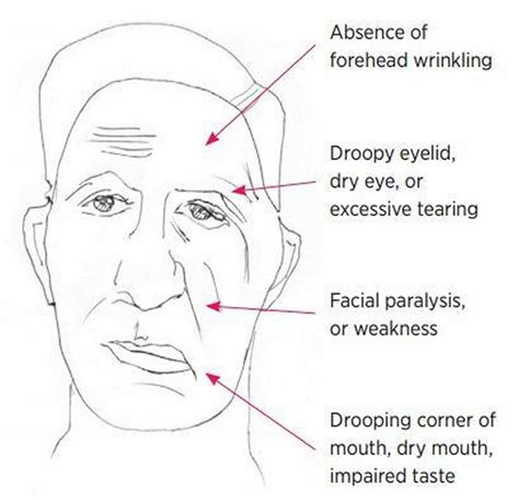 lab test for bell's palsy