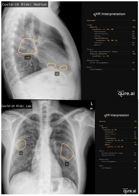 Labcorp Chest X Ray