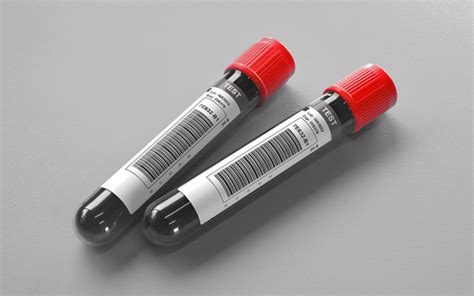 Labcorp Test Code For Oxcarbazepine