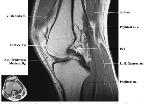 Labeled Knee Mri