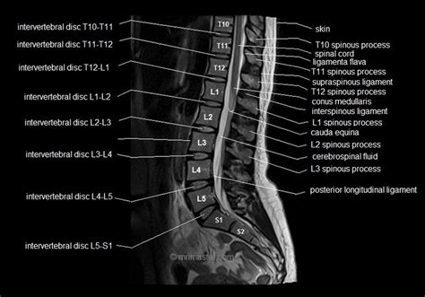 Labeled Lumbar Mri