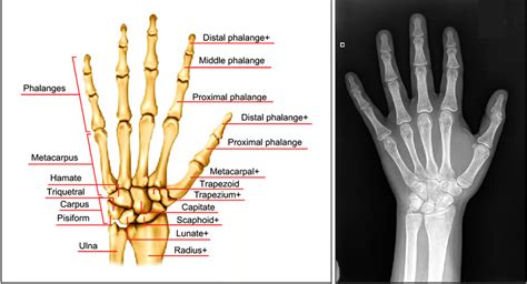Labeled X Ray Of Hand