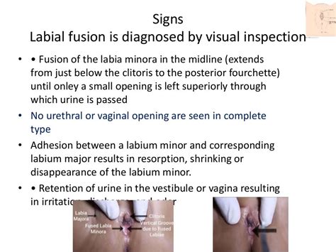 Labial Adhesion Pronounce