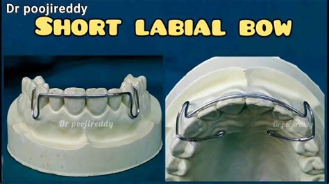 Labial Orthodontics