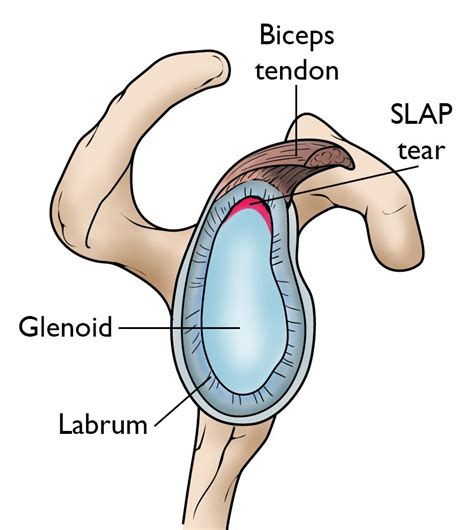 Labrum Slap Tear Shoulder: Causes, Symptoms, and Effective Treatment