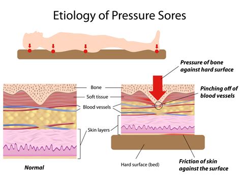lack of blood flow causes a pressure sore