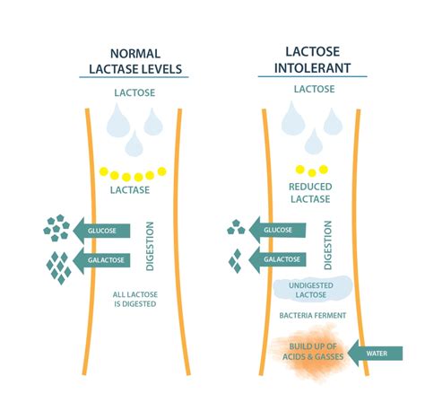 Lactose Intolerance
