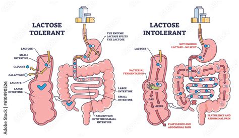 Lactose Intolerance Anatomy