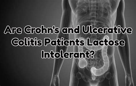 Lactose Intolerance Ulcerative Colitis