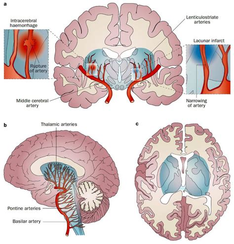lacunar infarctions of the brain