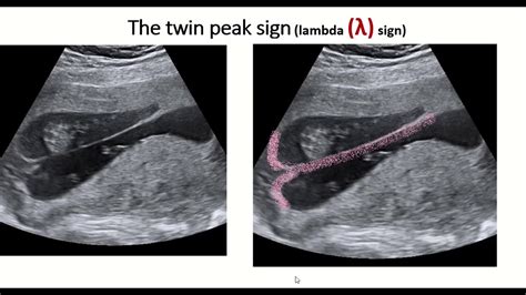 Lambda Sign Twins