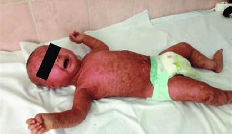 Lamellar Ichthyosis Newborn Baby Suffers Rare Severe Condition
