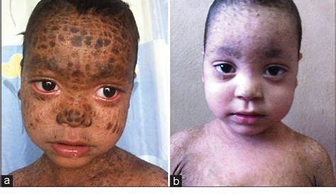 Lamellar Ichthyosis Treatment Topical Application Of Tazarotene In The Of