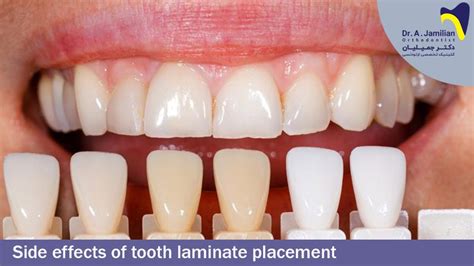 Laminate Teeth Side Effects