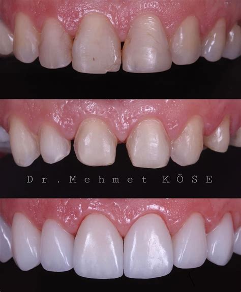Laminate Veneers Longevity