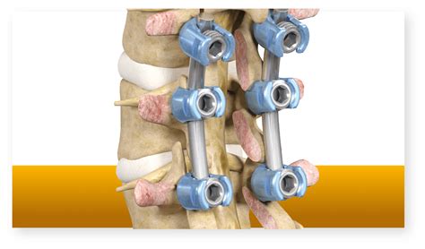 Laminectomy and Fusion: Effective Treatment for Spinal Conditions