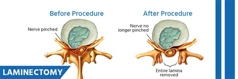 laminectomy cost