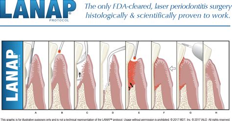 Lanap Dental Procedure Code