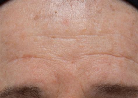 Lancer Method Before And After