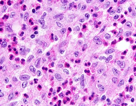 langerhans cell histiocytosis genetics