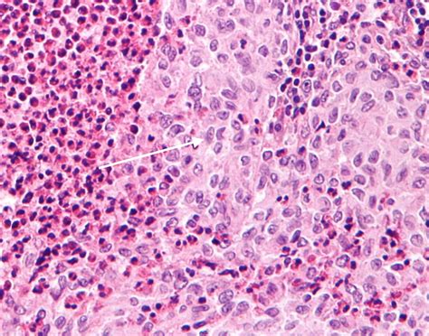 langerhans cell histiocytosis histopathology