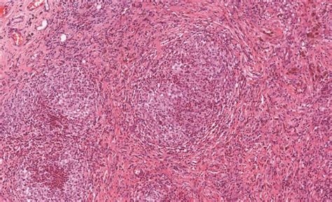 langerhans cell histiocytosis ncbi