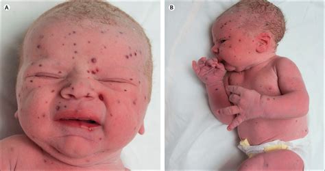 langerhans cell histiocytosis pictures