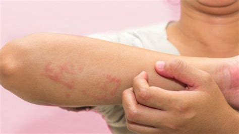 langkah-langkah mengatasi alergi kulit