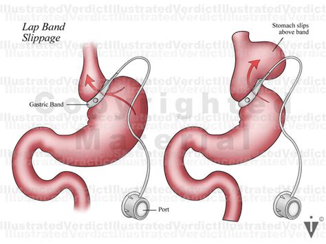 Lap Band Removal Cpt Code