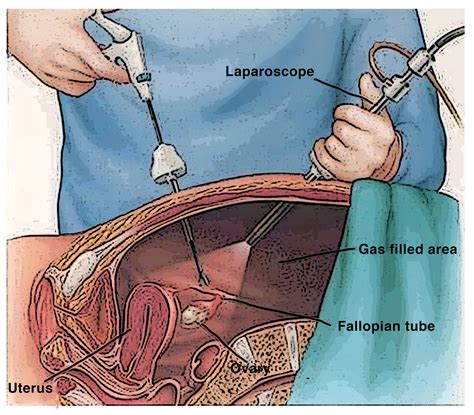 lap excision of endometriosis cpt