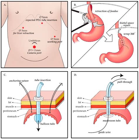 lap gastrostomy tube placement cpt code