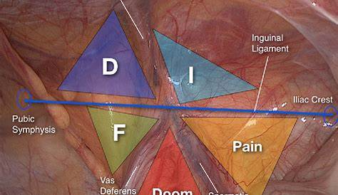 Laparoscopic Inguinal Hernia Repair Triangle Of Doom Anatomy Essentials For