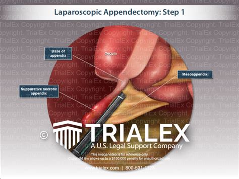 Recover Faster with Laparoscopic Appendix Operation: What You Need to Know