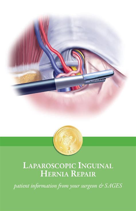 laparoscopic direct inguinal hernia repair