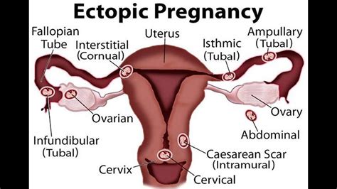 Laparoscopic Ectopic Pregnancy Cpt Code