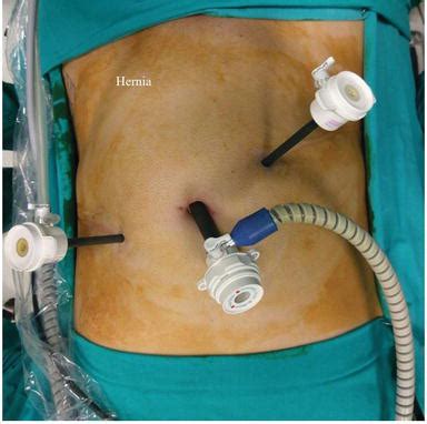 laparoscopic inguinal hernia surgery video