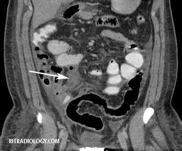 large bowel anastomotic leak icd 10
