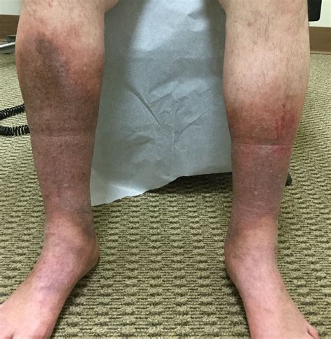 large brown spots on legs