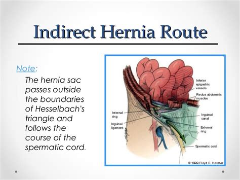 large right inguinal hernia