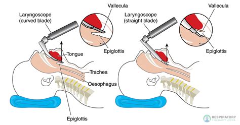 Laryngoscopy Intubation