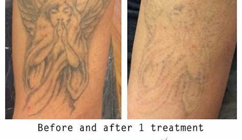 Laser Tattoo Removal After 1 Session For Exgang Members Mark Cost