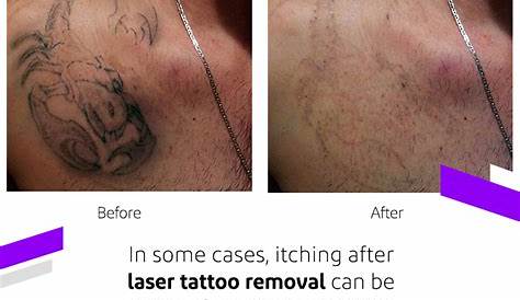Laser Tattoo Removal Aftercare Itching How To Take Care Your After A