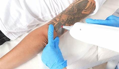 Tattoo Removal Treatment Laser Free Tattoo Ideas